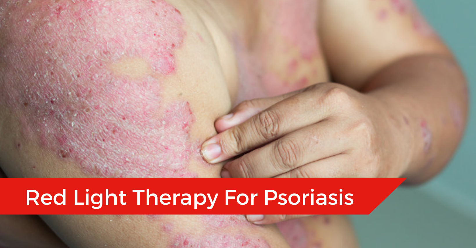 Red Light Therapy For Psoriasis Does